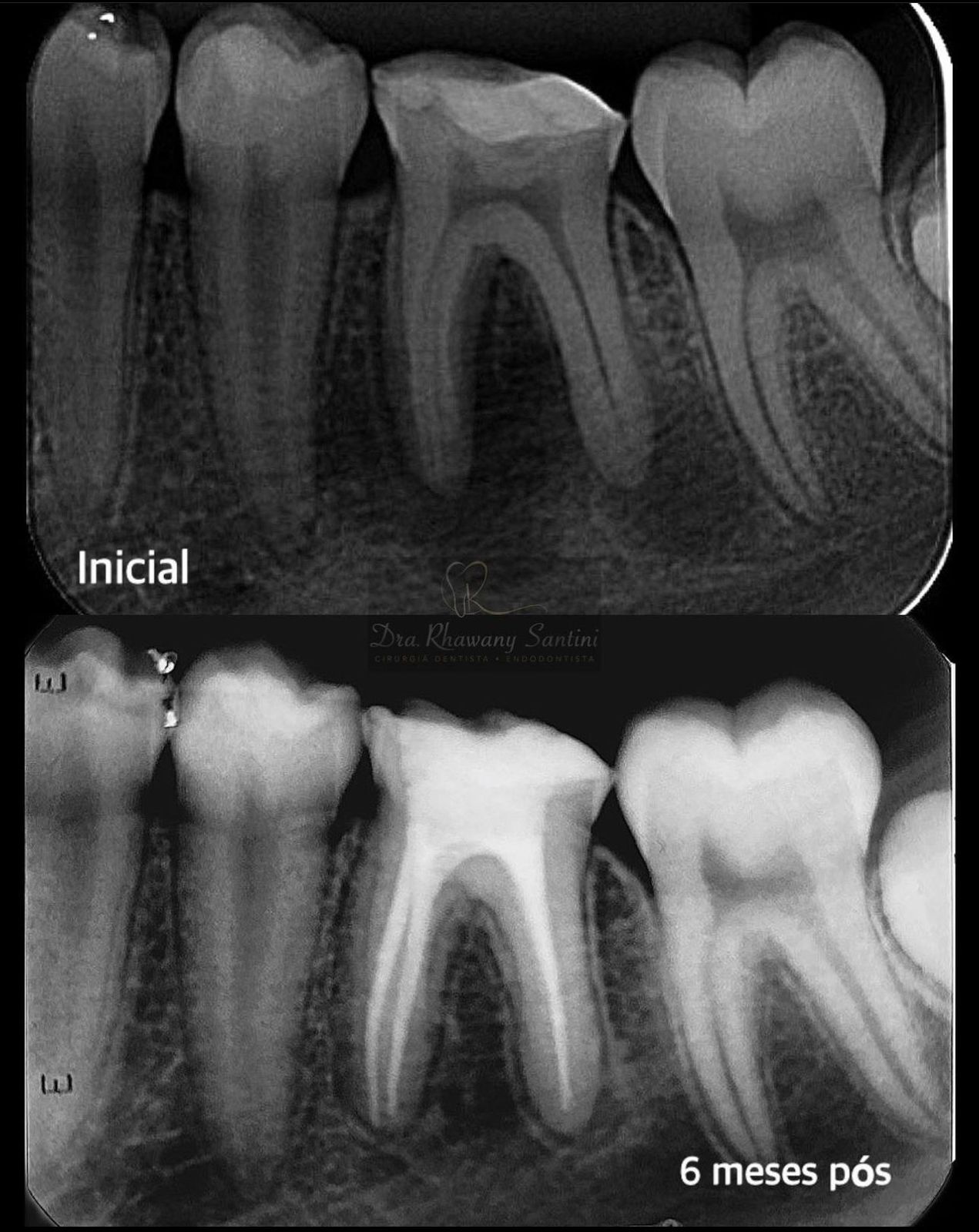 Endodontia em Presidente Prudente: conheça o tratamento de canal